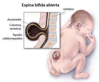 Discapacidad Espina Bífida