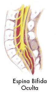 Discapacidad Espina Bífida