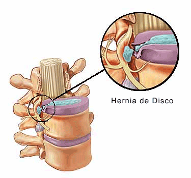 Hernia Discal