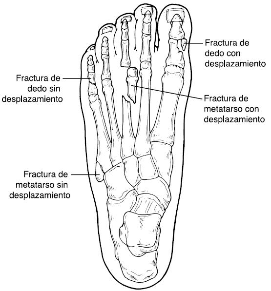 Fractura Ósea