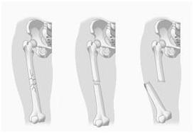 Fractura Ósea
