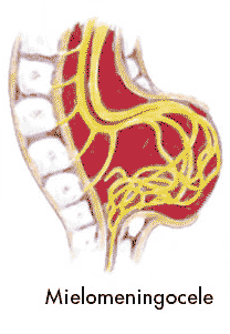espina bifida quistica-mielomeningocele